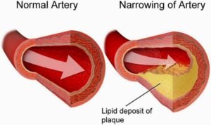 Narrowing of artery by lipid deposit of plaque