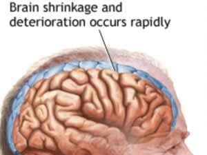 vCJD: Brain shrinkage and deterioration occurs rapidly