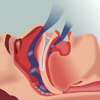 Breathing patterns during sleep